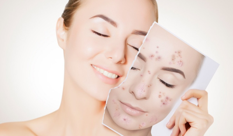 Akne - gan pusaudžiem, gan pieaugušajiem