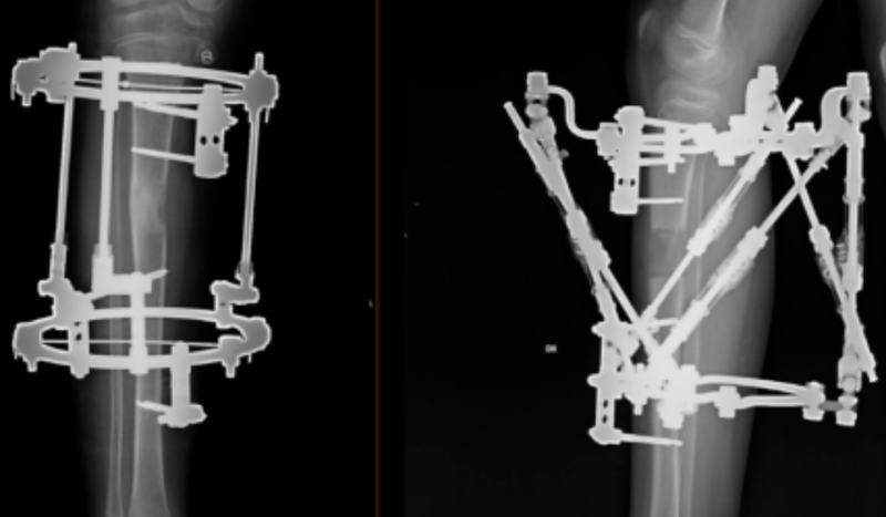 Ekstremitāšu asimetrijas un deformāciju korekcija
